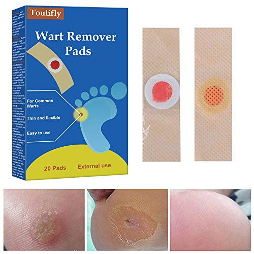 Wart Remover 20ml WART REMOVER Lutateo - Palmilhas e inserções - 20 ml, remover verrugas